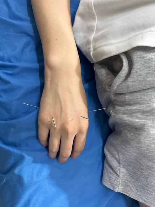 颈椎压迫神经可以针灸