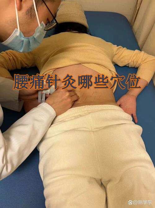 腰疼针灸需要几个疗程