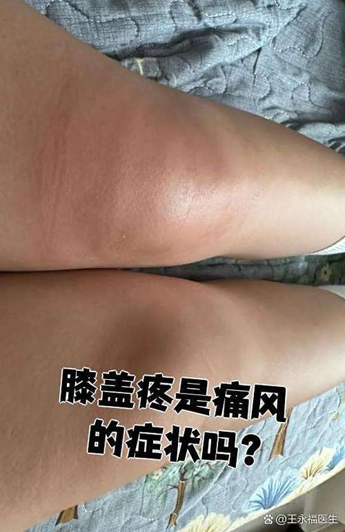 痛风 膝盖症状有哪些