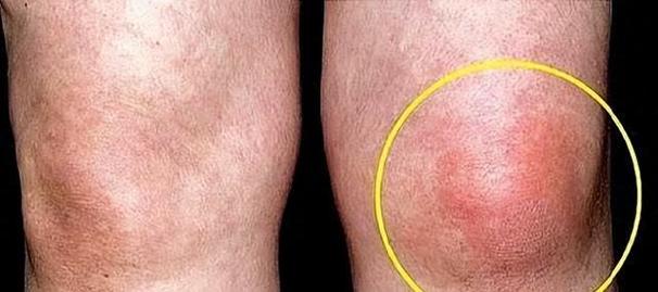 痛风 膝盖症状有哪些