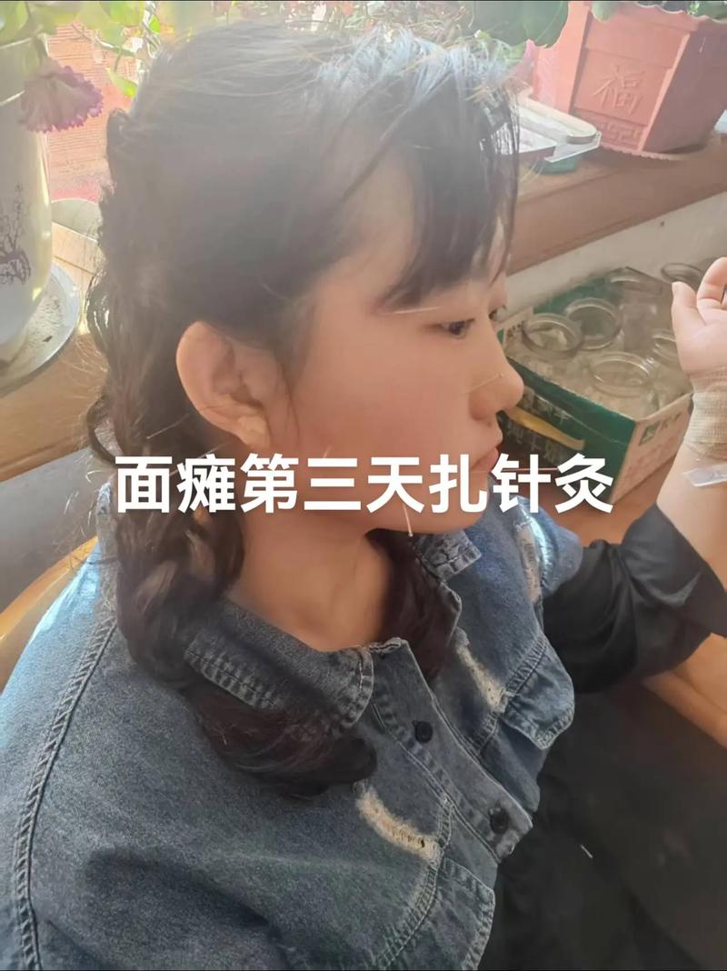 面瘫针灸多久可以洗头