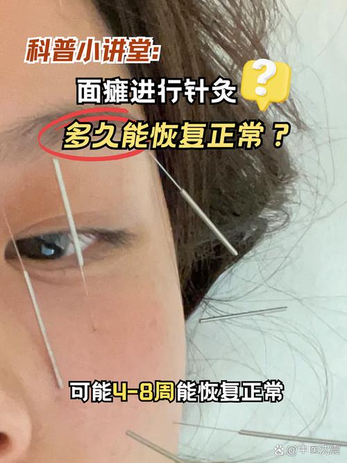 面瘫针灸多久恢复味觉