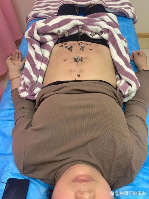 做完宫腔镜可以针灸吗