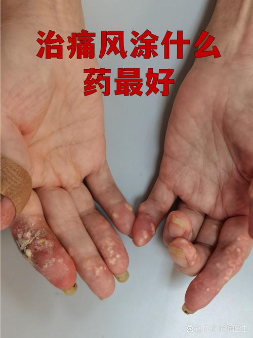 痛风 轻微疼痛 擦药