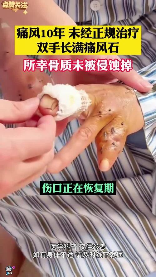 痛风第一次就有痛风石