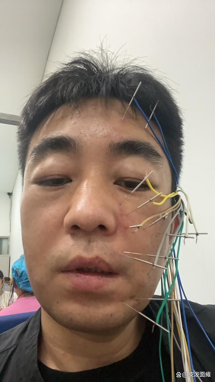 面瘫针灸三个月也没好