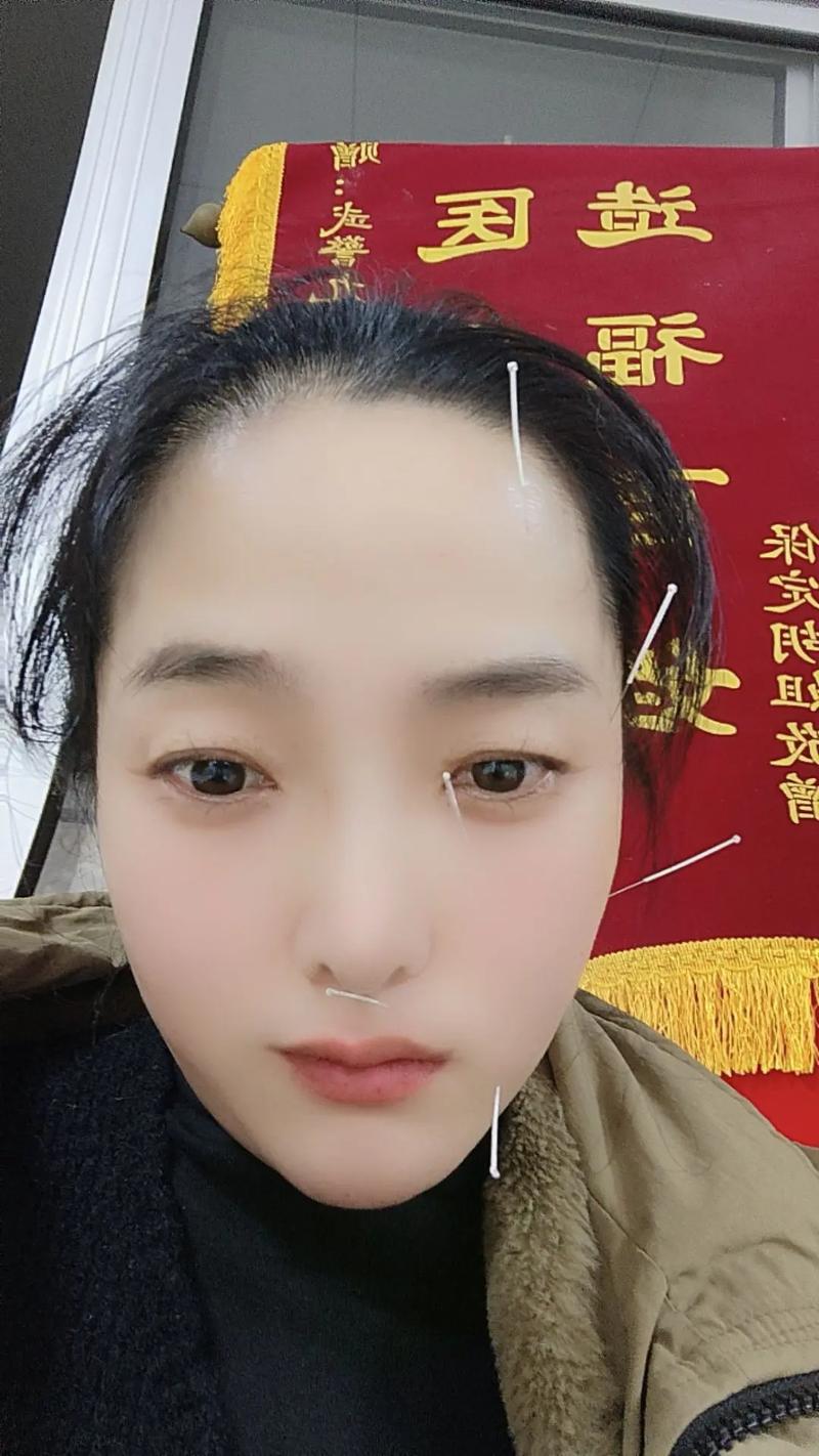 面瘫针灸三个月也没好