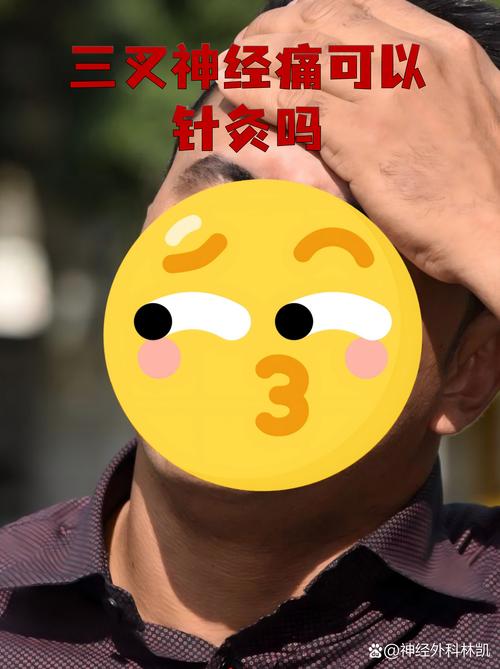 三叉神经痛可以针灸吗