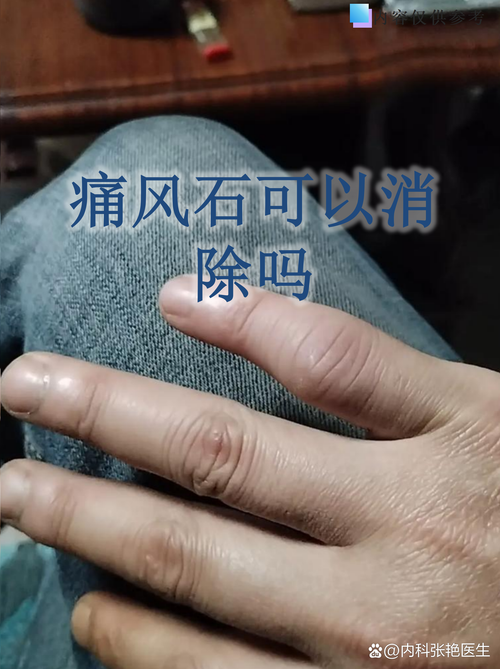 痛风多久才会有痛风石