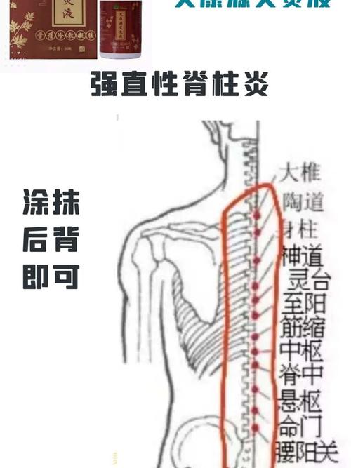 强直性脊柱炎不要针灸