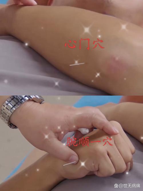 网球肘针灸灸那几个位