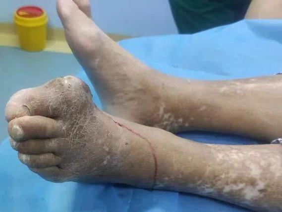 吃非布司他后痛风发作