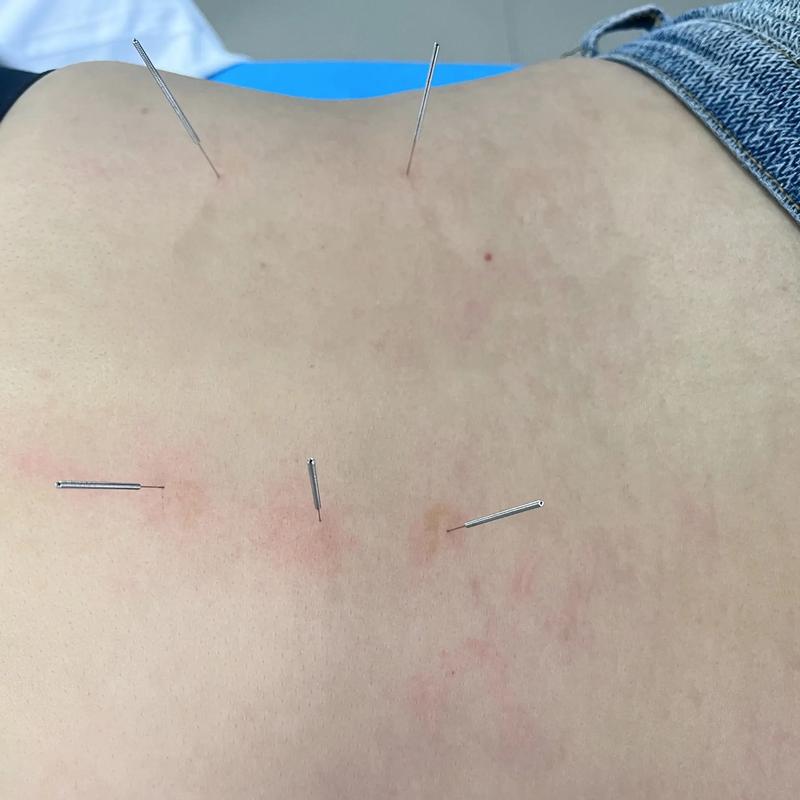 颞颌关节炎针灸有用吗