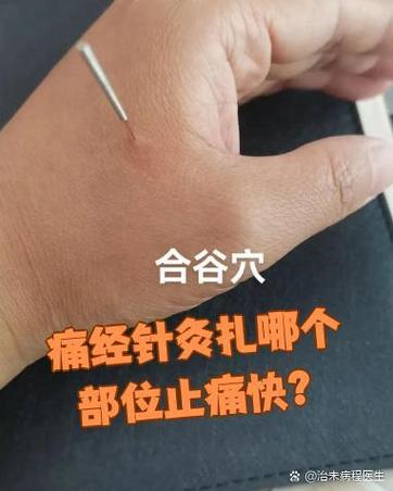 针灸后小腹胀痛怎么办