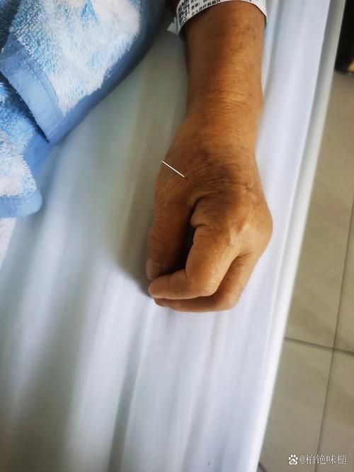 针灸扎的针越多越好吗