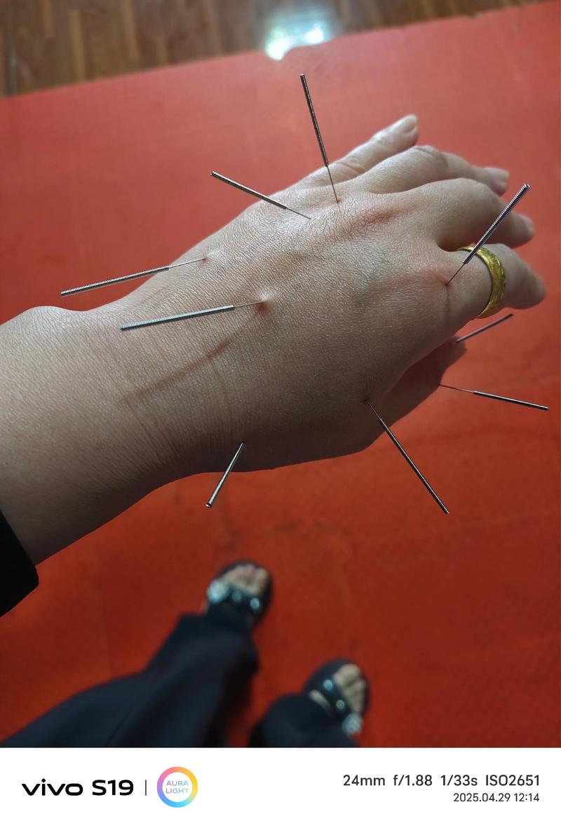 梅核气针灸的具体位置