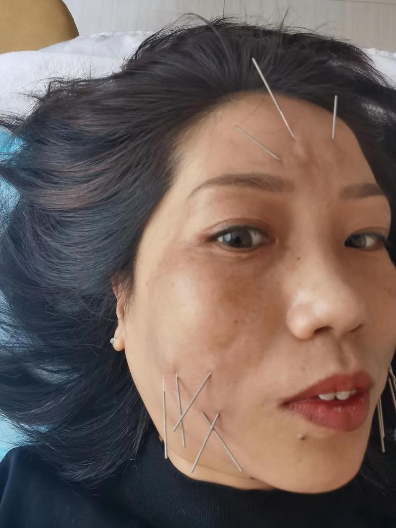 针灸去斑需要多长时间