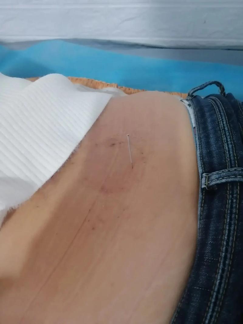 针灸治好了腰间盘突出