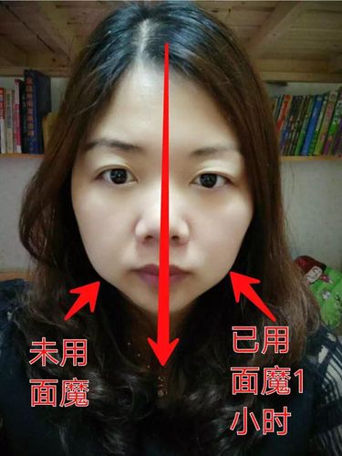 贴针灸面魔有副作用吗