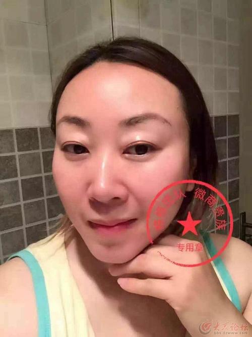 贴针灸面魔有副作用吗