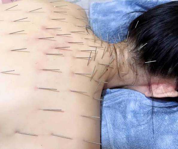 盆腔炎针灸效果怎么样