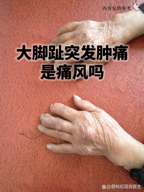 脚趾肿疼一定是痛风吗