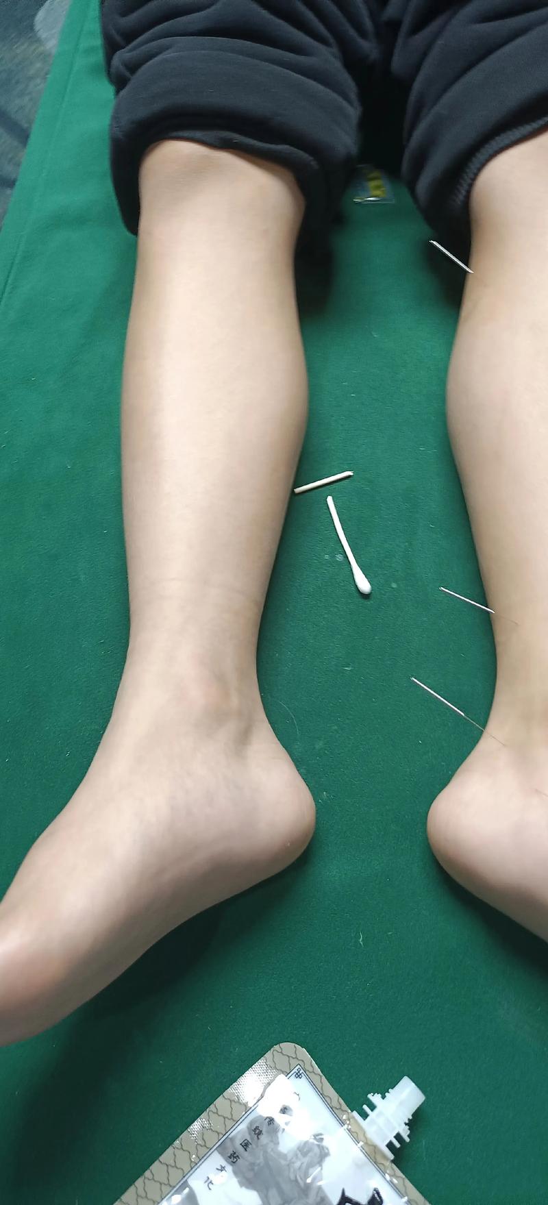 针灸治近视眼的副作用