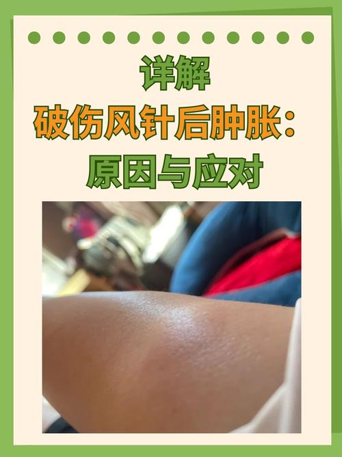 脸部针灸后肿了怎么办