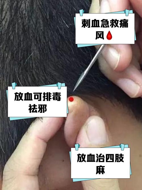 针灸拔针出偏黑血好吗