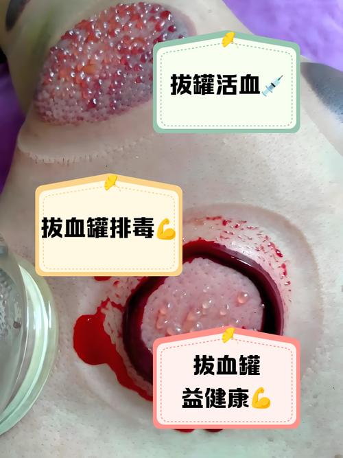 针灸拔针出偏黑血好吗