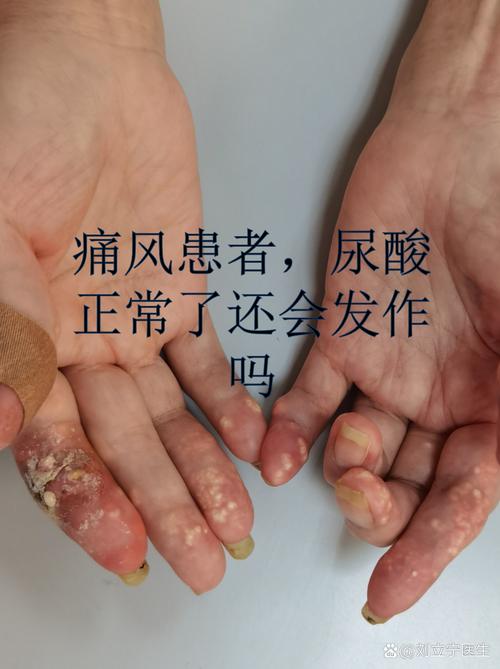 西安交大一附院 痛风