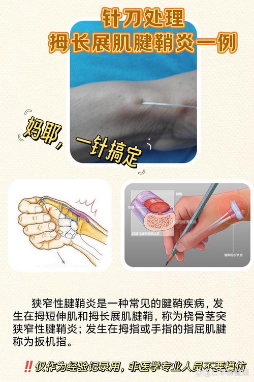 腱鞘炎针灸后注意事项