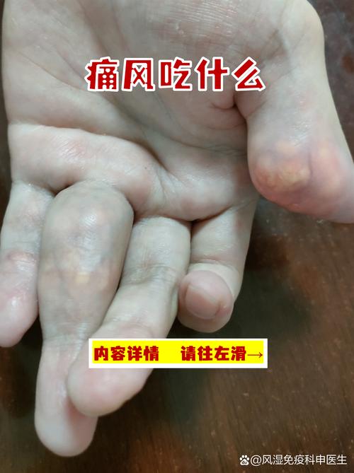 痛风能吃的东西是什么