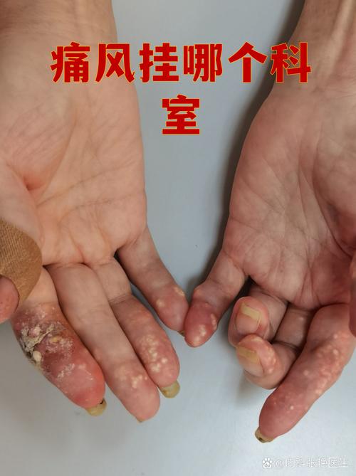 那个痛风关节炎医院好