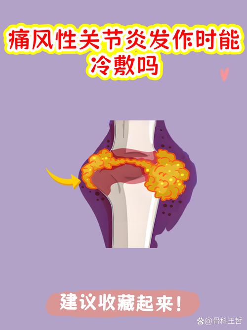 痛风发作冰敷还是热敷