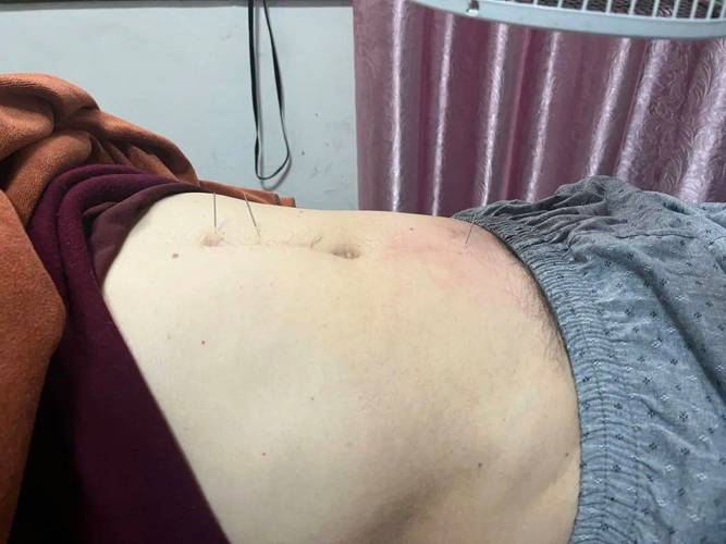 针灸能治前列腺增生吗