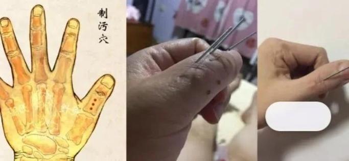 针灸能治前列腺增生吗