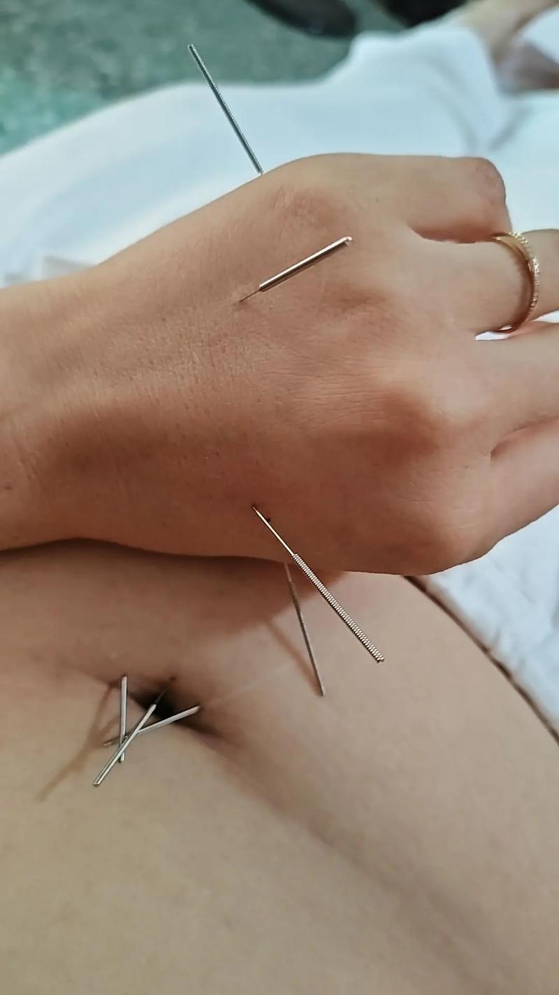 坐骨神经针灸后更疼了