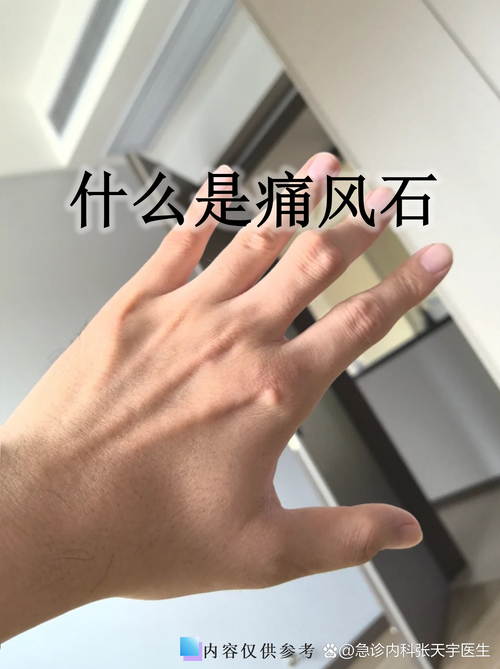 痛风与肾结石有关系吗