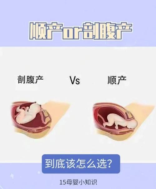 剖腹产与顺产哪个安全