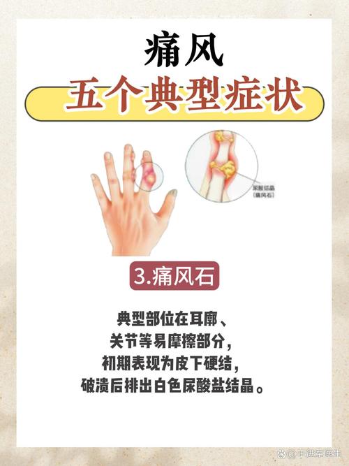 什么样的人容易的痛风