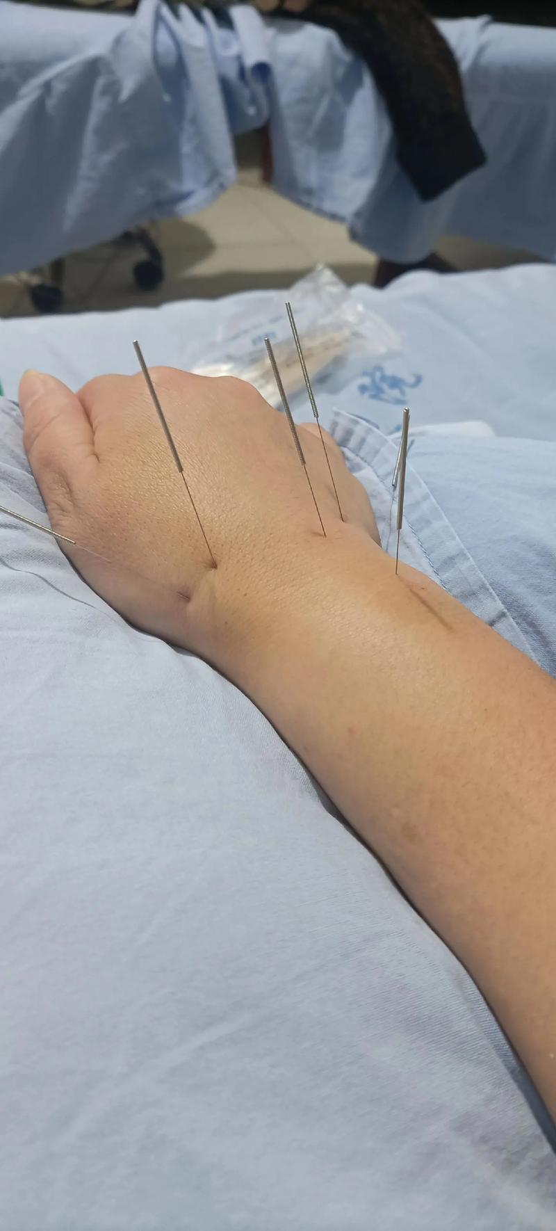 腕管综合征可以针灸吗