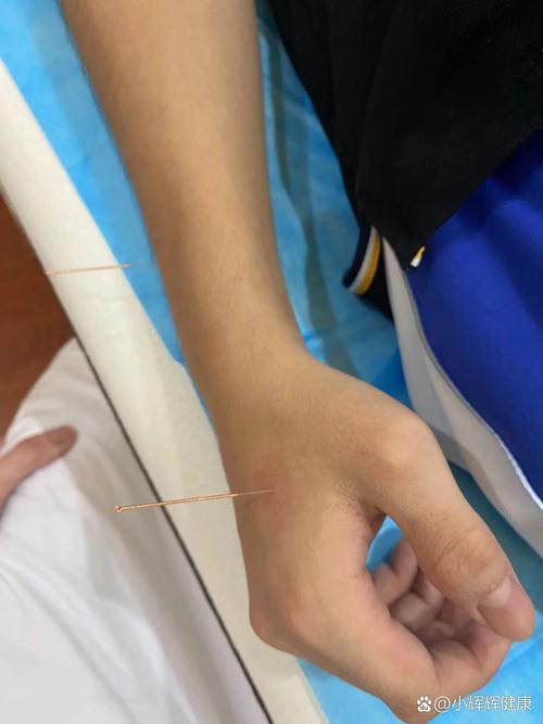 儿童抽动症针灸可以吗