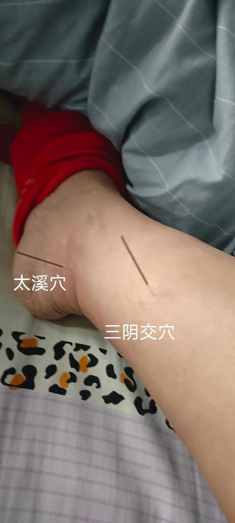 中医治疗三高针灸穴位