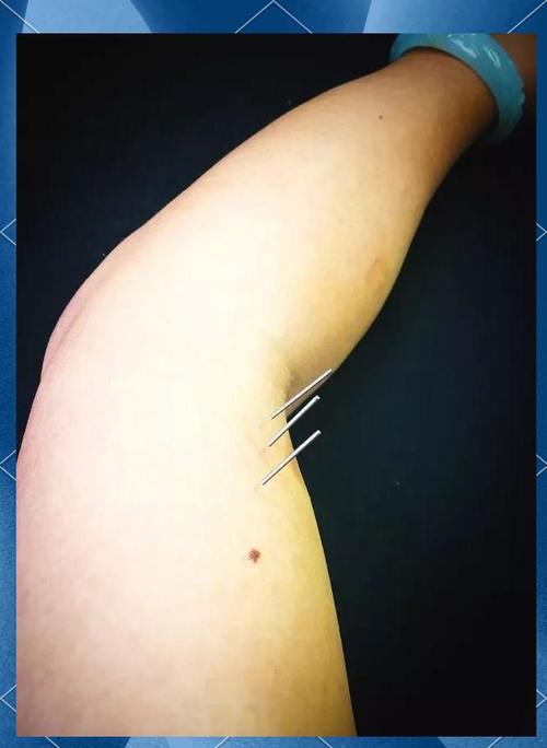 中医治疗三高针灸穴位