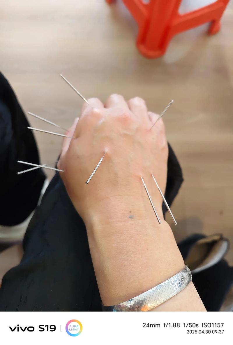 手针灸后肿了怎么回事