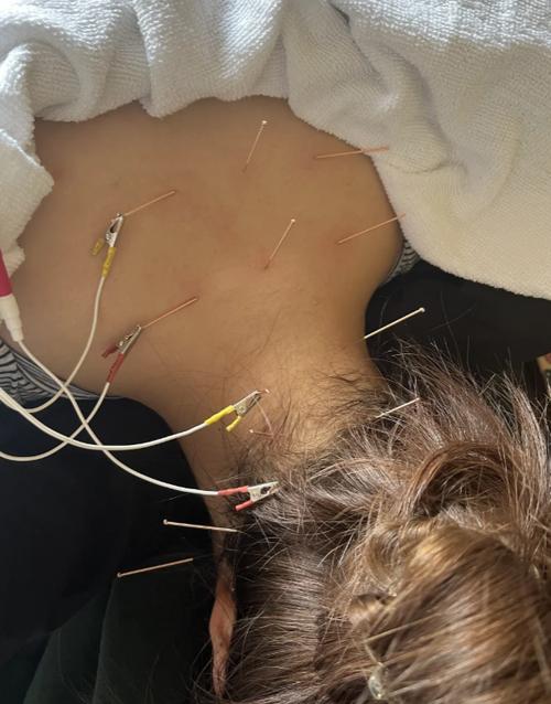 针灸治疗颈椎病靠谱么