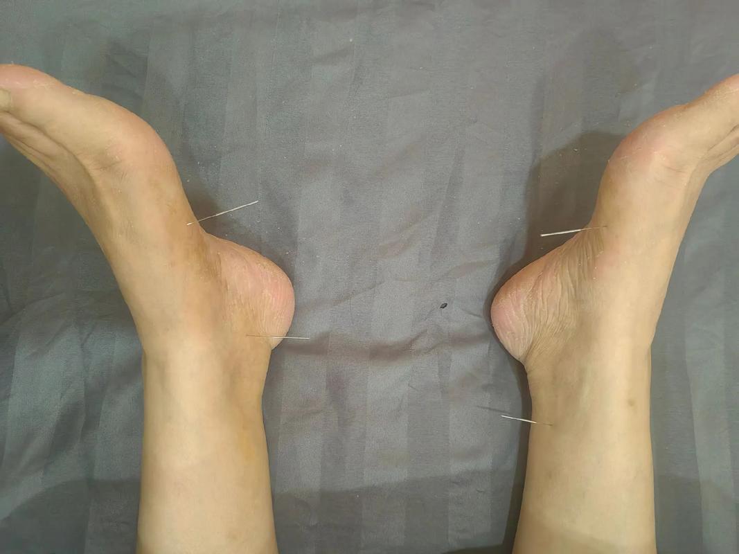 针灸治感冒效果怎么样