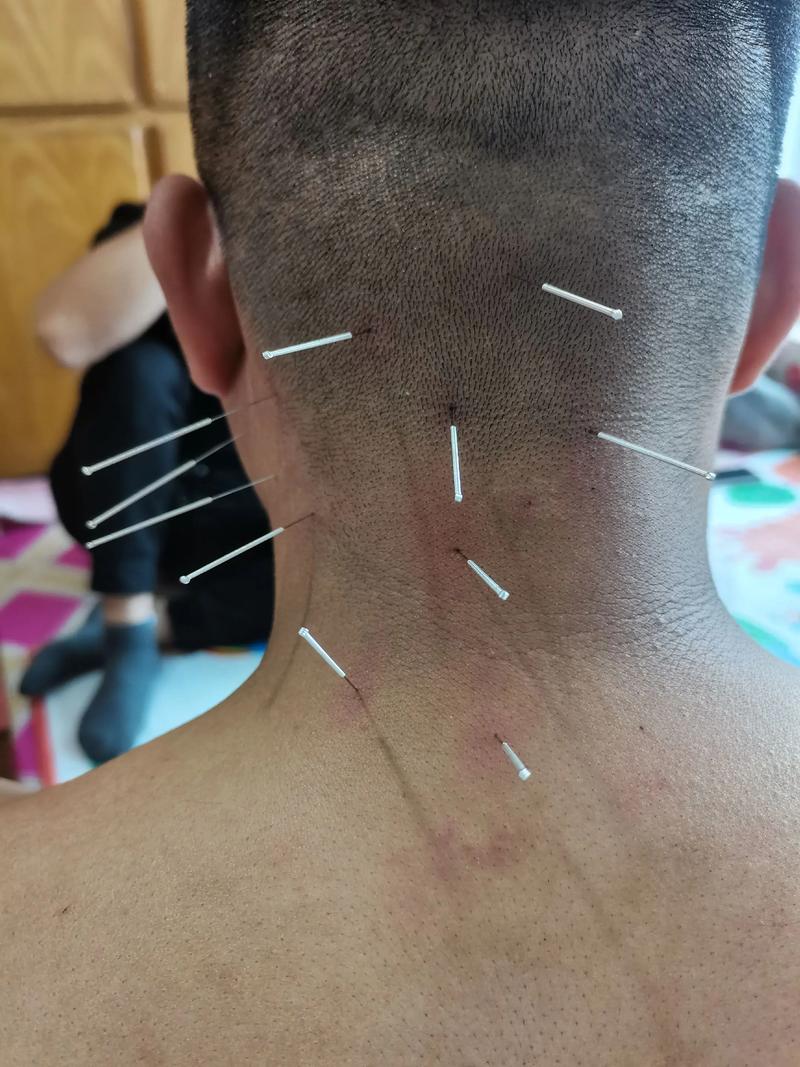 针灸颈椎会有后遗症吗