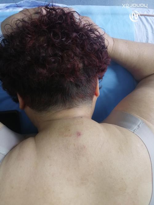 针灸后头晕恶心好几天